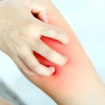 coceira-persistente-nas-pernas-pode-indicar-problemas-nas-veias